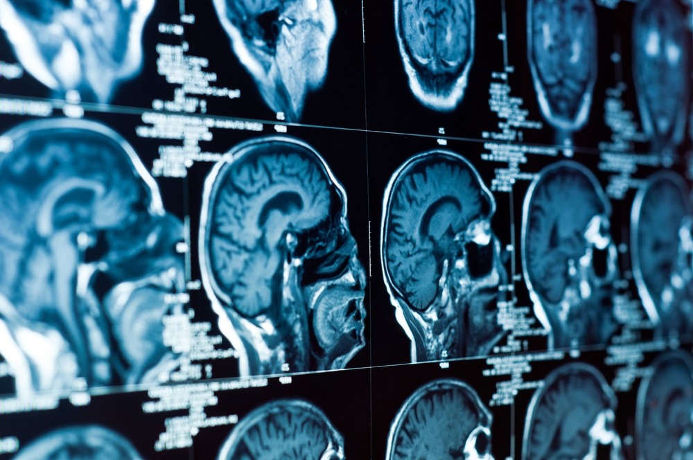 Brain scans of a brain injury.