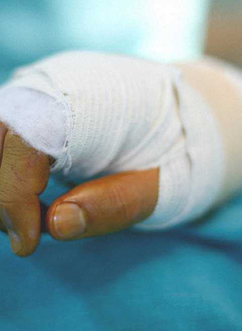 Closeup of a hand wrapped in a cast.